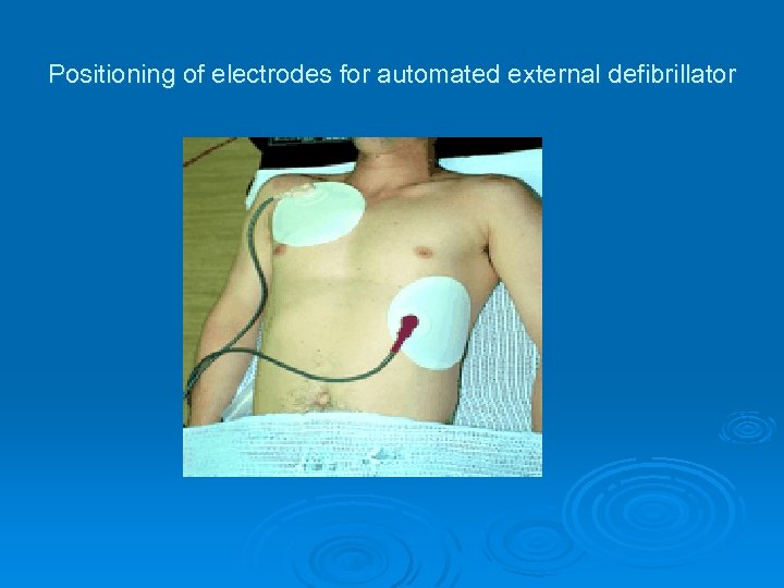 Positioning of electrodes for automated external defibrillator 