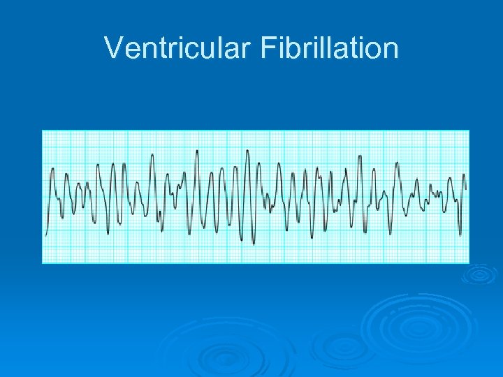 Ventricular Fibrillation 