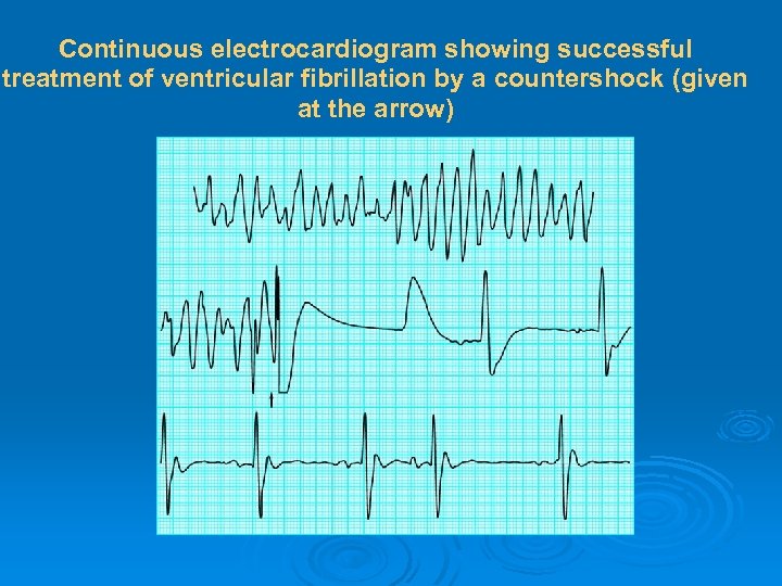 Continuous electrocardiogram showing successful treatment of ventricular fibrillation by a countershock (given at the