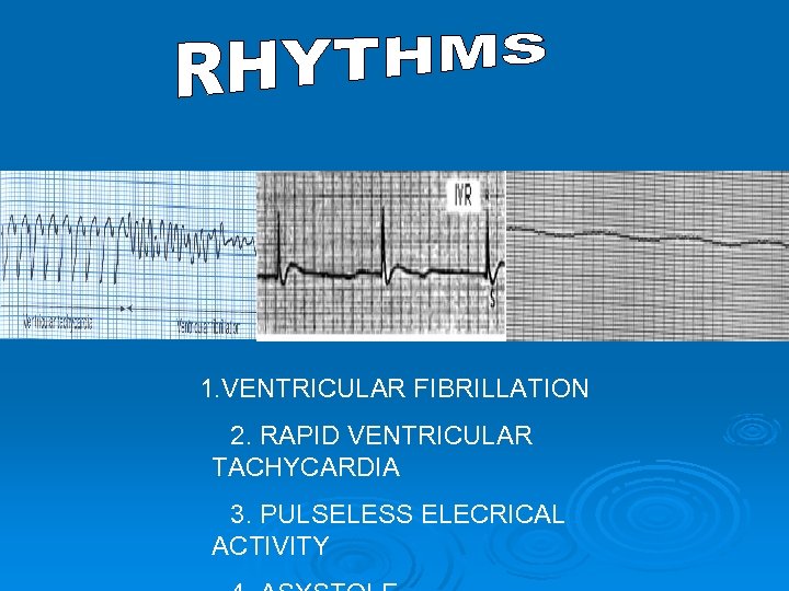 1. VENTRICULAR FIBRILLATION 2. RAPID VENTRICULAR TACHYCARDIA 3. PULSELESS ELECRICAL ACTIVITY 