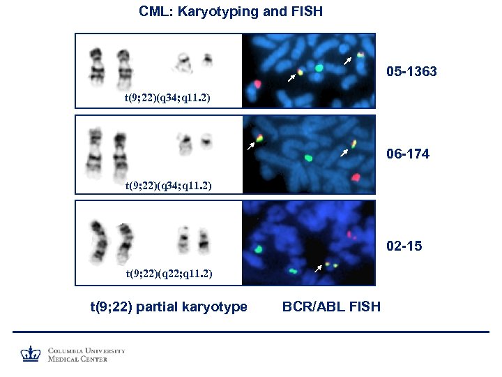 CML: Karyotyping and FISH 05 -1363 t(9; 22)(q 34; q 11. 2) 06 -174