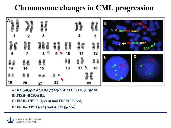 Chromosome changes in CML progression A: Karyotype: 47, XX, t(9; 22)(q 34; q 11.