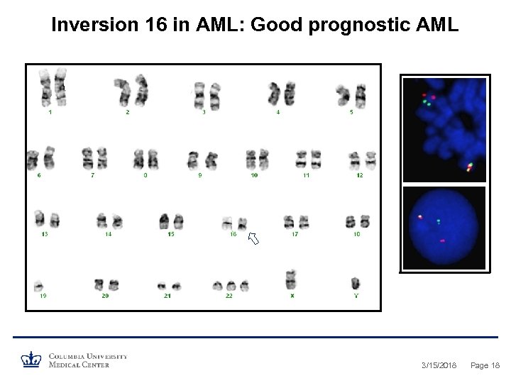 Inversion 16 in AML: Good prognostic AML 3/15/2018 Page 18 