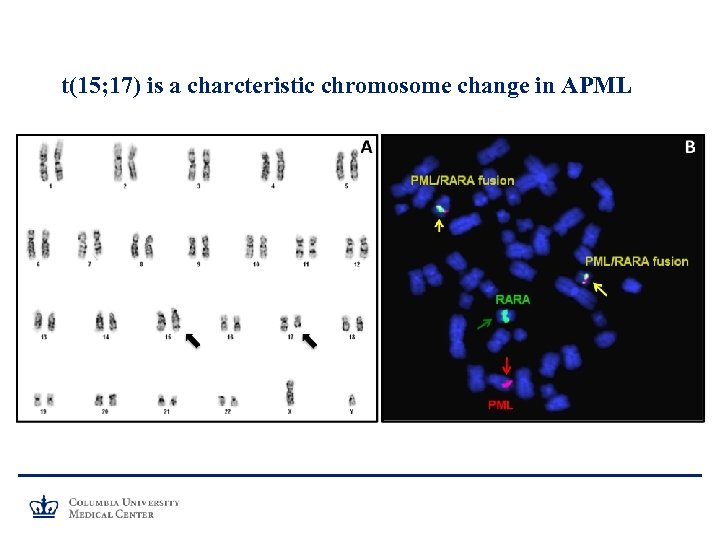 t(15; 17) is a charcteristic chromosome change in APML 