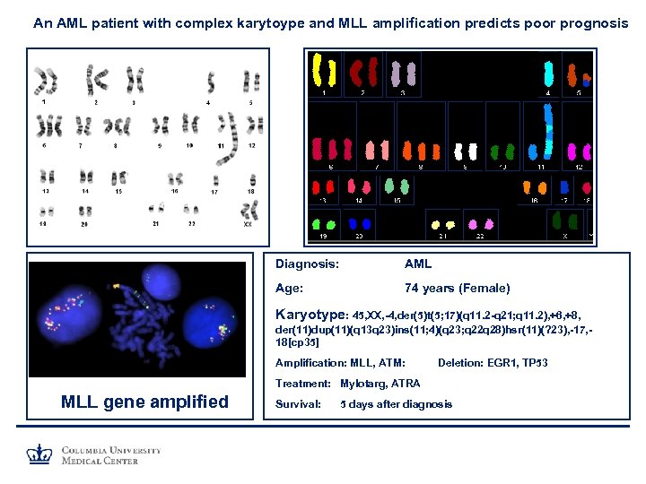 An AML patient with complex karytoype and MLL amplification predicts poor prognosis Diagnosis: AML