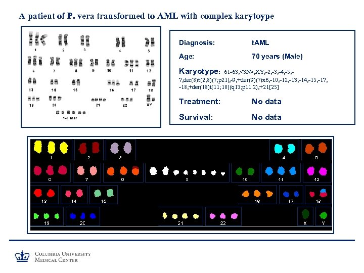 A patient of P. vera transformed to AML with complex karytoype Diagnosis: t. AML