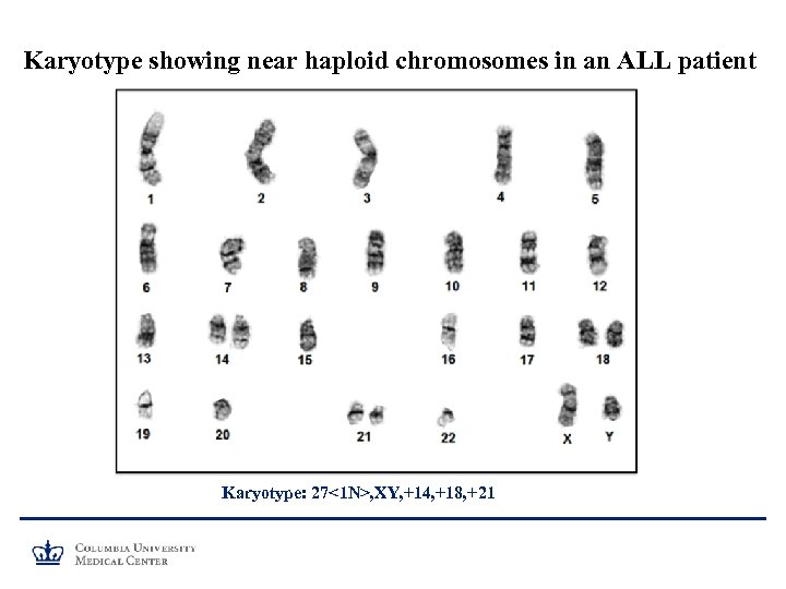 Karyotype showing near haploid chromosomes in an ALL patient Karyotype: 27<1 N>, XY, +14,