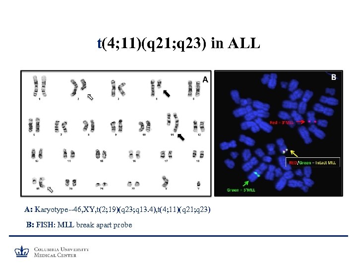 t(4; 11)(q 21; q 23) in ALL A: Karyotype--46, XY, t(2; 19)(q 23; q