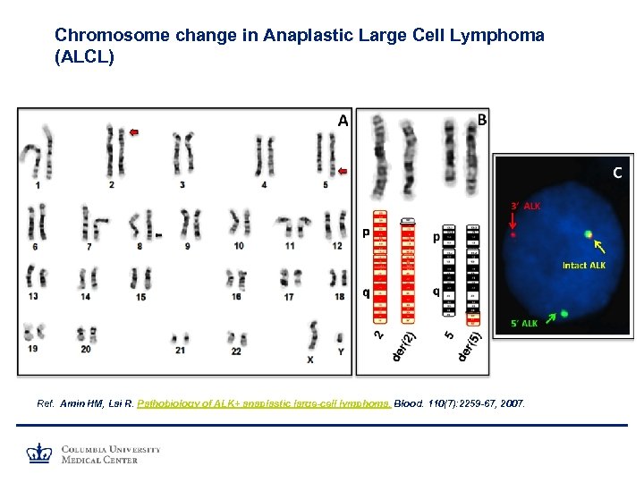 Chromosome change in Anaplastic Large Cell Lymphoma (ALCL) Ref. Amin HM, Lai R. Pathobiology