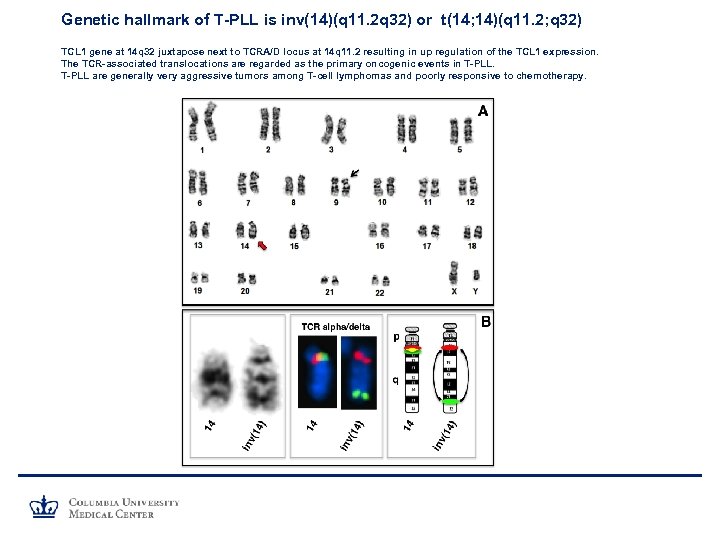 Genetic hallmark of T-PLL is inv(14)(q 11. 2 q 32) or t(14; 14)(q 11.