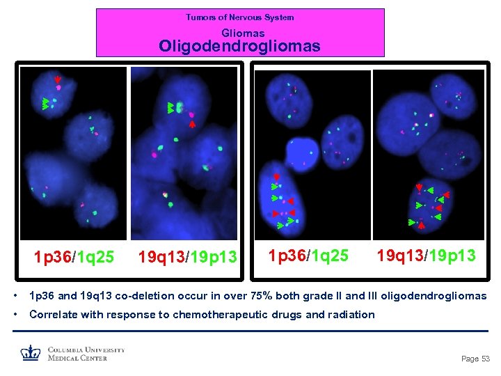 Tumors of Nervous System Gliomas Oligodendrogliomas 1 p 36/1 q 25 19 q 13/19