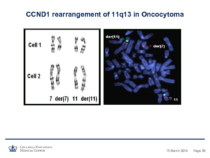 CCND 1 rearrangement of 11 q 13 in Oncocytoma 15 March 2018 Page 59