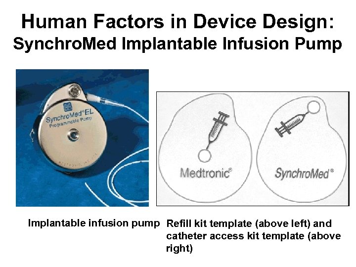 Human Factors in Device Design: Synchro. Med Implantable Infusion Pump Implantable infusion pump Refill