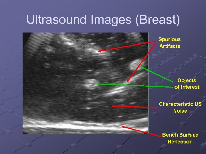 Ultrasound Images (Breast) Spurious Artifacts Objects of Interest Characteristic US Noise Bench Surface Reflection