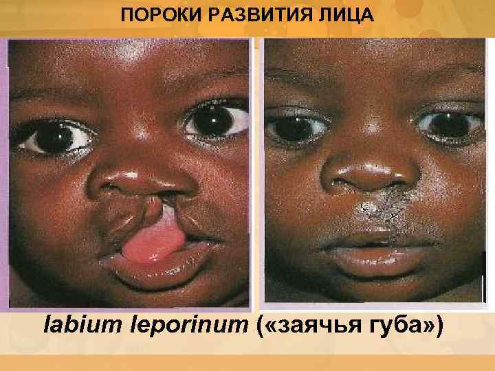 ПОРОКИ РАЗВИТИЯ ЛИЦА labium leporinum ( «заячья губа» ) 