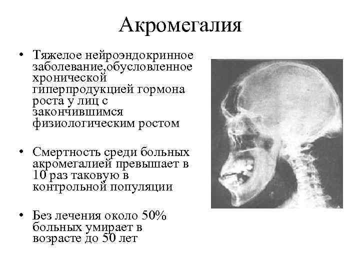Акромегалия • Тяжелое нейроэндокринное заболевание, обусловленное хронической гиперпродукцией гормона роста у лиц с закончившимся