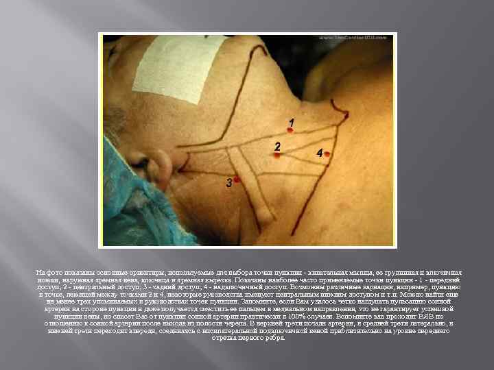 На фото показаны основные ориентиры, используемые для выбора точки пункции - кивательная мышца, ее