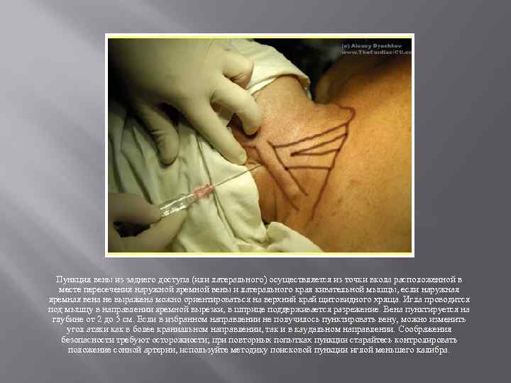 Пункция вены из заднего доступа (или латерального) осуществляется из точки вкола расположенной в месте