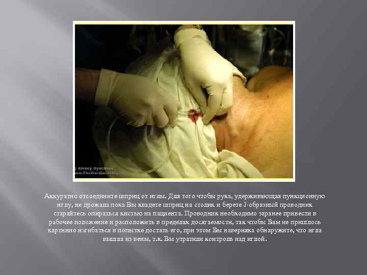 Аккуратно отсоедините шприц от иглы. Для того чтобы рука, удерживающая пункционную иглу, не дрожала
