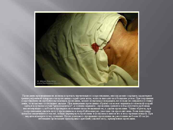 Проводник при введении не должен встречать значительного сопротивления, иногда можно ощущать характерное трение рифленной