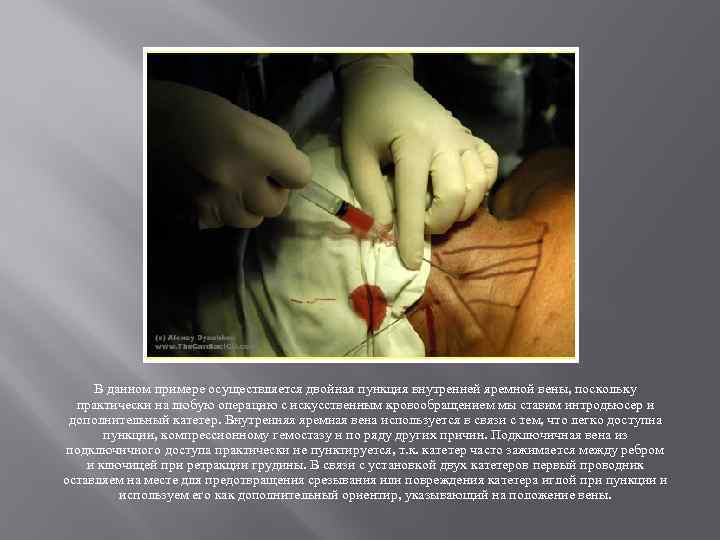 В данном примере осуществляется двойная пункция внутренней яремной вены, поскольку практически на любую операцию