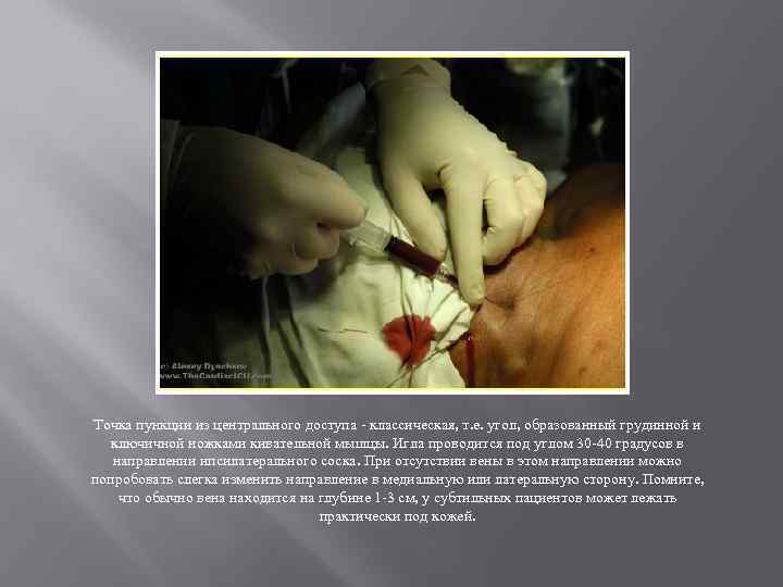 Точка пункции из центрального доступа - классическая, т. е. угол, образованный грудинной и ключичной