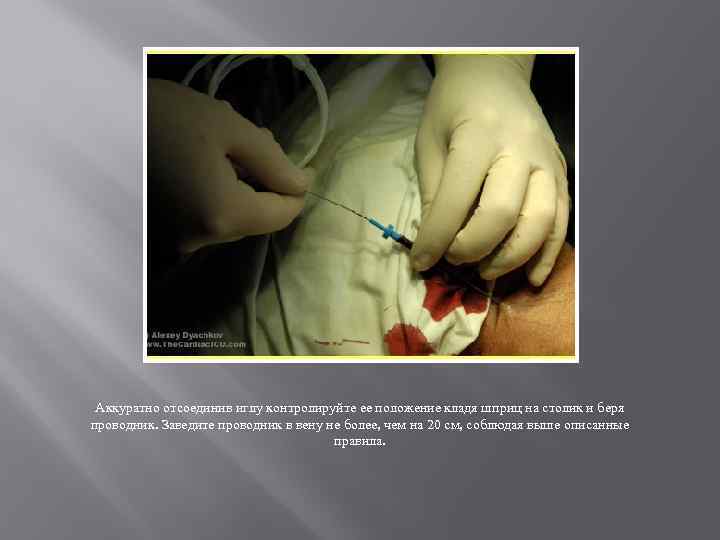Аккуратно отсоединив иглу контролируйте ее положение кладя шприц на столик и беря проводник. Заведите