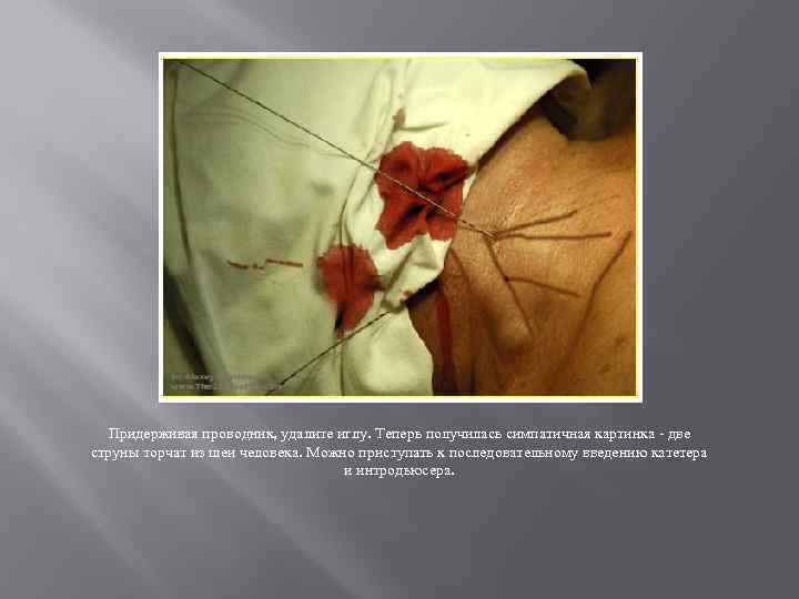 Придерживая проводник, удалите иглу. Теперь получилась симпатичная картинка - две струны торчат из шеи
