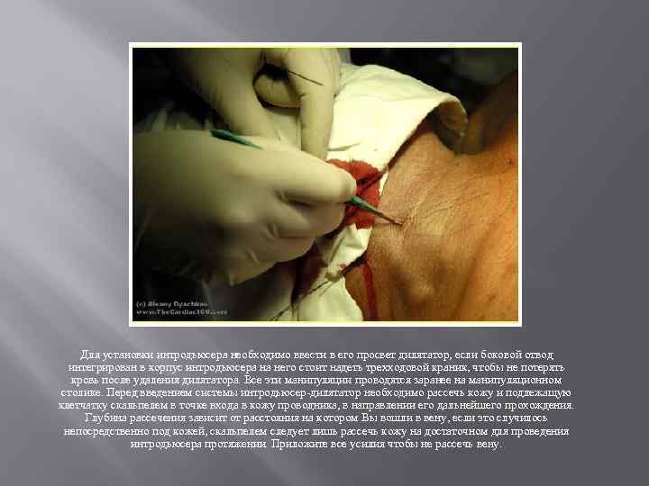 Для установки интродьюсера необходимо ввести в его просвет дилятатор, если боковой отвод интегрирован в