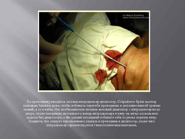 По проводнику вводится система интродьюсер-дилятатор. Старайтесь брать катетер пальцами ближе к коже, чтобы избежать