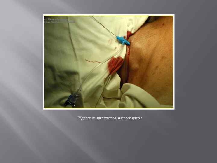 Удаление дилятатора и проводника 
