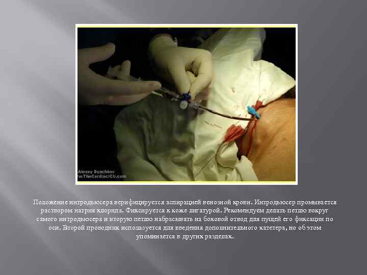 Положение интродьюсера верифицируется аспирацией венозной крови. Интродьюсер промывается раствором натрия хлорида. Фиксируется к коже