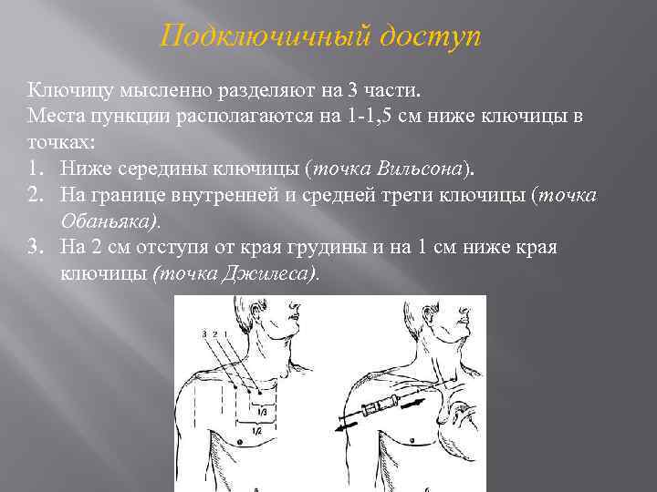 Подключичный доступ Ключицу мысленно разделяют на 3 части. Места пункции располагаются на 1 -1,