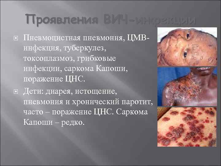Проявления ВИЧ-инфекции Пневмоцистная пневмония, ЦМВинфекция, туберкулез, токсоплазмоз, грибковые инфекции, саркома Капоши, поражение ЦНС. Дети: