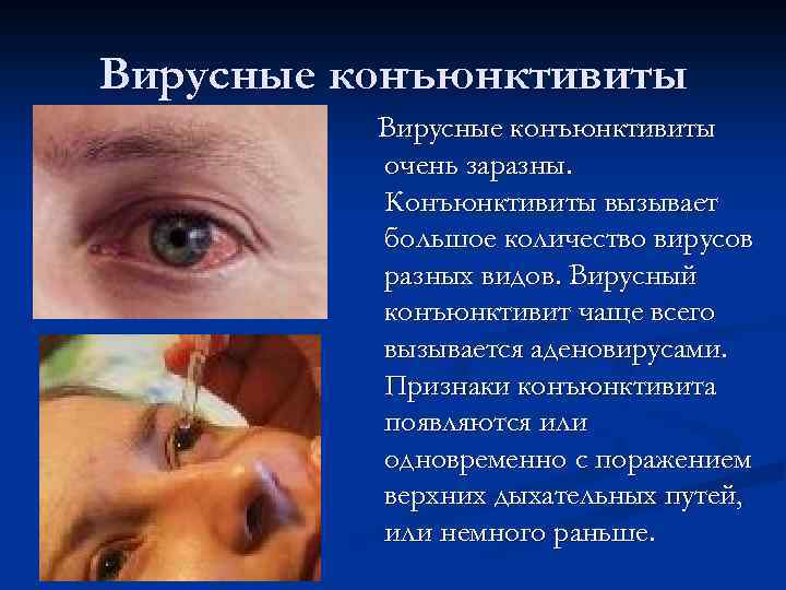 Вирусные конъюнктивиты очень заразны. Конъюнктивиты вызывает большое количество вирусов разных видов. Вирусный конъюнктивит чаще