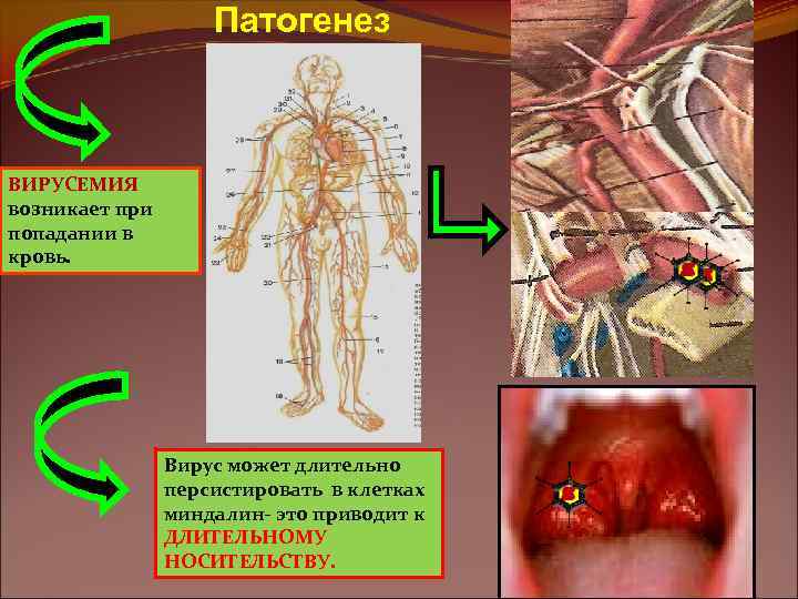 Патогенез ВИРУСЕМИЯ возникает при попадании в кровь. Вирус может длительно персистировать в клетках миндалин-