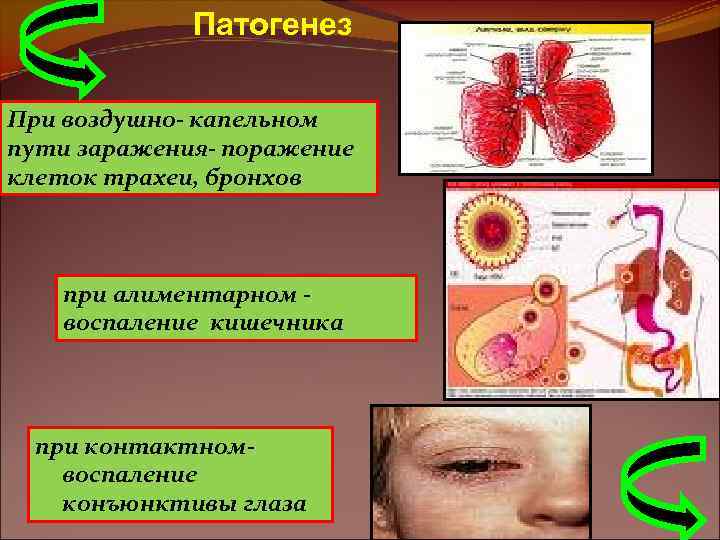 Патогенез При воздушно- капельном пути заражения- поражение клеток трахеи, бронхов при алиментарном воспаление кишечника