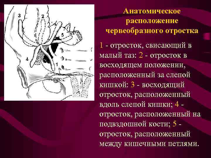 Локализация острого аппендицита