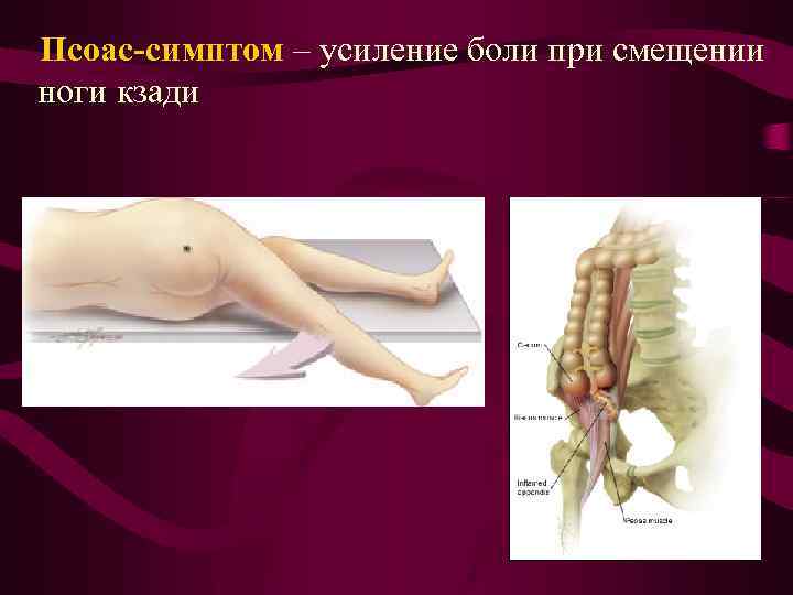 Псоас-симптом – усиление боли при смещении ноги кзади 