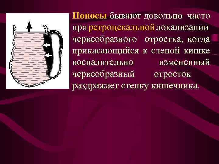 Поносы бывают довольно часто при ретроцекальной локализации червеобразного отростка, когда прикасающийся к слепой кишке