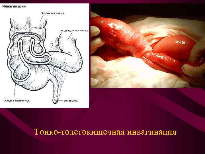 Тонко-толстокишечная инвагинация 