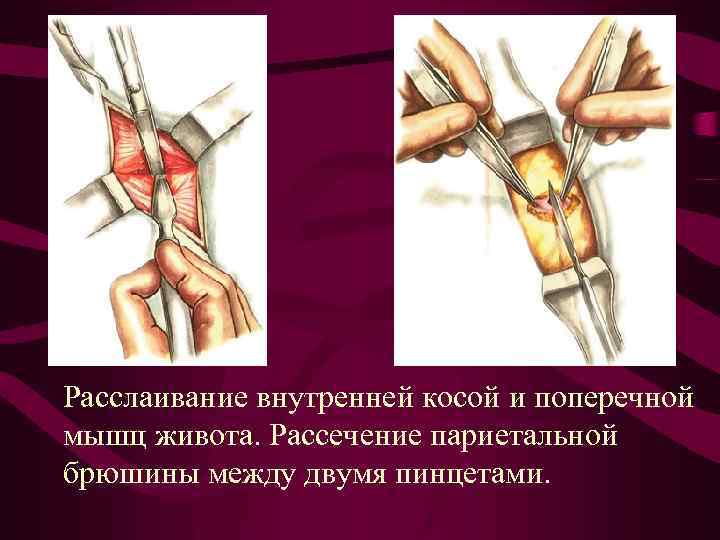 Расслаивание внутренней косой и поперечной мышц живота. Рассечение париетальной брюшины между двумя пинцетами. 