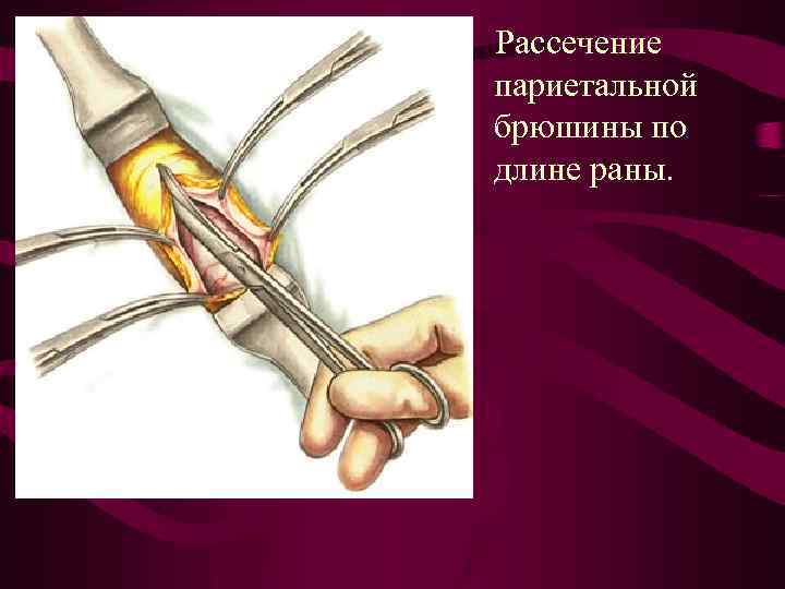 Рассечение париетальной брюшины по длине раны. 