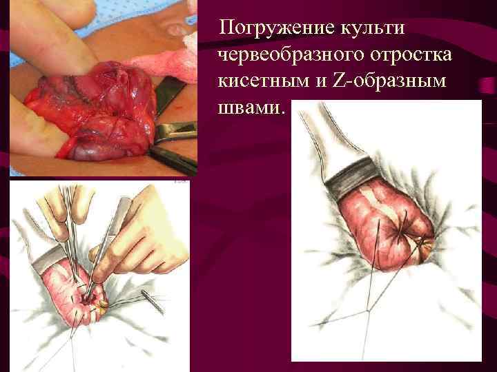 Погружение культи червеобразного отростка кисетным и Z-образным швами. 