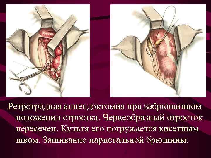 Ретроградная аппендэктомия при забрюшинном положении отростка. Червеобразный отросток пересечен. Культя его погружается кисетным швом.