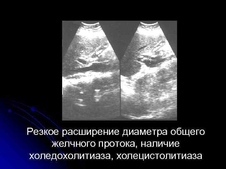 Резкое расширение диаметра общего желчного протока, наличие холедохолитиаза, холецистолитиаза 