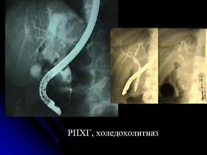 РПХГ, холедохолитиаз 