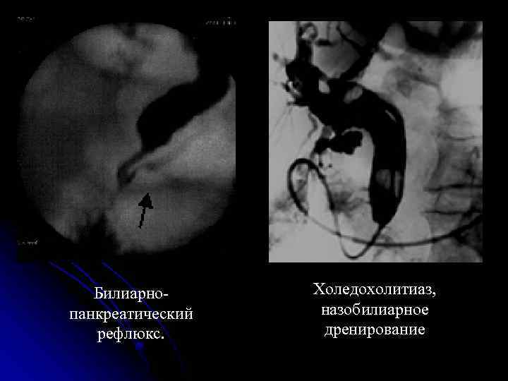 Билиарнопанкреатический рефлюкс. Холeдохолитиаз, назобилиарное дренирование 