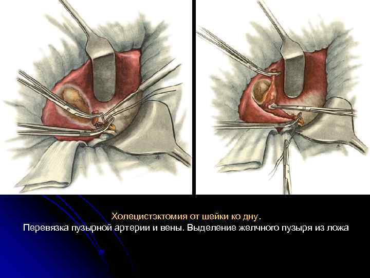 Холецистэктомия от шейки ко дну. Перевязка пузырной артерии и вены. Выделение желчного пузыря из