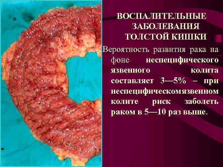 ВОСПАЛИТЕЛЬНЫЕ ЗАБОЛЕВАНИЯ ТОЛСТОЙ КИШКИ Вероятность развития рака на фоне неспецифического язвенного колита составляет 3—